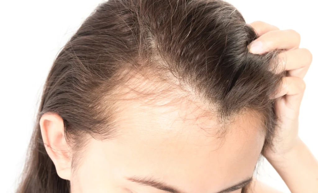 Treatment for Alopecia Areata in Bangalore