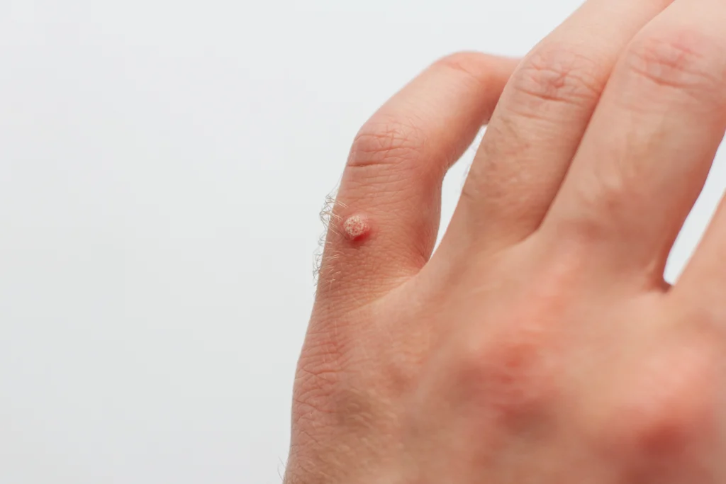 Wart Removal Treatment in Bangalore