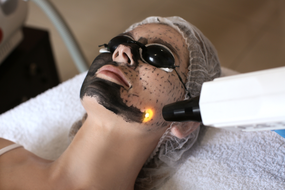 Why the Carbon Laser Peel is the New Go-To for Sensitive Skin
